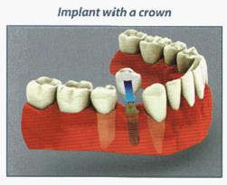 Dental Implant Sun City